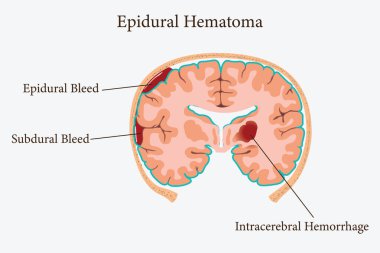 Etiketli kısımlarla beyin kanaması gösteren epidural hematomun tıbbi bir örneği. 10 saniye.
