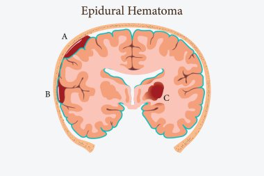 Etiketli kısımlarla beyin kanaması gösteren epidural hematomun tıbbi bir örneği. 10 saniye.
