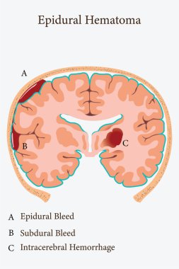 Etiketli kısımlarla beyin kanaması gösteren epidural hematomun tıbbi bir örneği. 10 saniye.