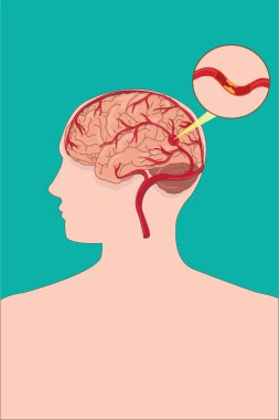 İskemik inme, beyin atardamarının tıkandığını ve kan pıhtısının pıhtılaştığını gösteriyor. 10 saniye.