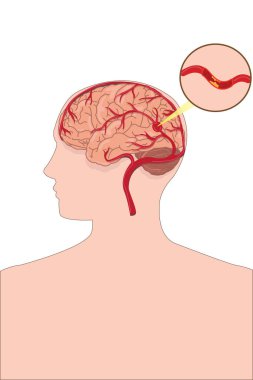 İskemik inme, beyin atardamarının tıkandığını ve kan pıhtısının pıhtılaştığını gösteriyor. 10 saniye.