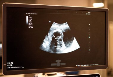 Ultrason monitörü muayene sırasında fetüsü gösteriyor. Hamilelik izleme için detaylı bir görüş sağlıyor.