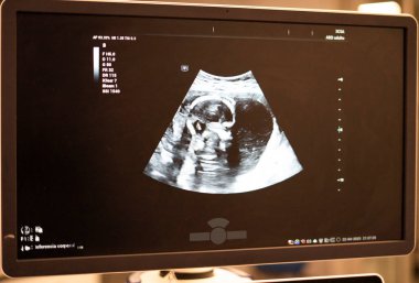 Ultrason monitörü hamilelik kontrolü sırasında cenini gösteriyor ve gelişimi hakkında detaylı bir görüş sağlıyor.