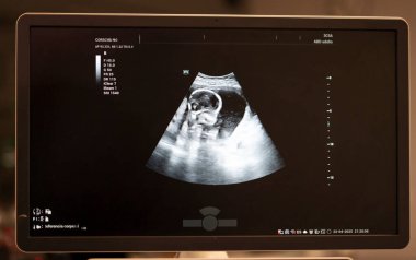 Ultrason monitörü hamilelik sırasında fetüs gelişimini gösteriyor. Bebeğin büyümesine önemli bir bakış sağlıyor.