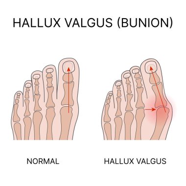 Hallux valgus 'un tıbbi vektör çizimi. Sağlıklı ayak ve deformasyon. Vektör illüstrasyonu