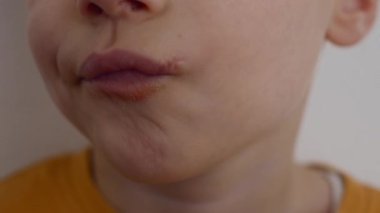 Dudakları yıpranmış ve dudaklarının derisi yüzülmüş bir çocuğun yakın çekimi. Yüksek kalite fotoğraf