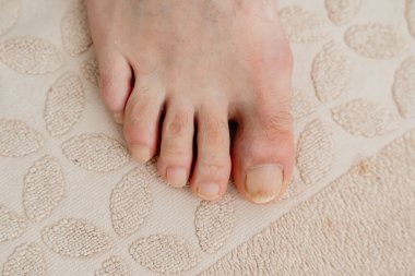 Manikür ve ayak mantarı olmayan bir adamın ayağına yakın çekim. Yüksek kalite fotoğraf