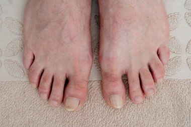 Close-up of a mens feet without manicure and toe fungus. High quality photo clipart