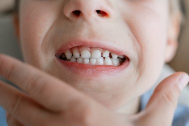 Childs 'ın ağzı, dişini gösteren bir parmak ile yakın plan, diş büyümesi ve gelişimi vurguluyor. Bir çocuğun merak ve heyecanını yakalıyor. 4 yaşındaki bir çocuğun bebek dişini kaybediyor.. 