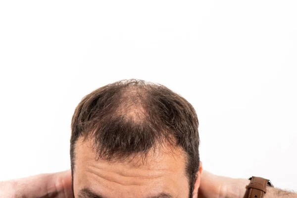 Großaufnahme Eines Jungen Mannes Mit Glatze Auf Weißem Hintergrund — Stockfoto