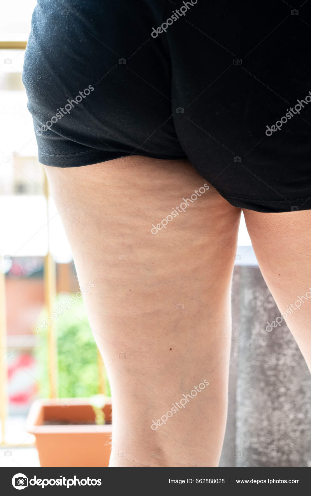 Female Leg Cellulite Dark Shorts Close Stock Photo by ©vfhnb12 662888028