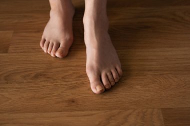 Hallux valgus, arka planda lamine döşeme üzerinde kadın bacakları. Bir kadının bacağında şişlik var..