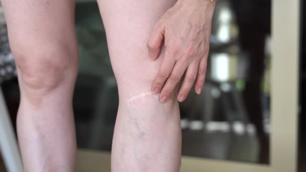 在女性腿特写镜头上发生意外后刀伤 一个女人挠着她那酸痛的伤疤 — 图库视频影像