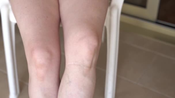 Scar Accident Female Leg Close Woman Scratches Her Aching Scar — Stock Video