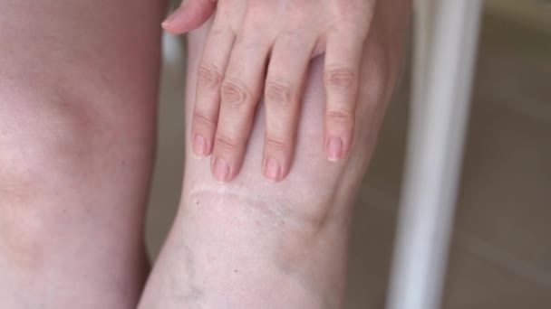 Шрам После Аварии Женской Ноге Крупным Планом Женщина Царапает Свой — стоковое видео