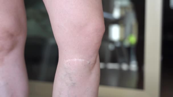 在女性腿特写镜头上发生意外后刀伤 一个女人挠着她那酸痛的伤疤 — 图库视频影像