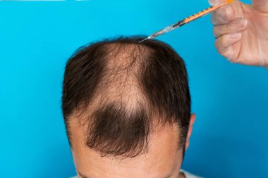 Eldivenlerinde şırınga olan bir doktor mavi arka planda alopesisi olan bir adama iğne yapıyor..