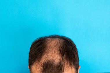 Mavi izole edilmiş arka planda genç bir adamın kel kafasının yakın çekimi..