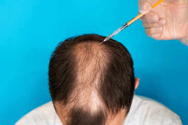 Eldivenlerinde şırınga olan bir doktor mavi arka planda alopesisi olan bir adama iğne yapıyor..