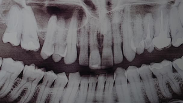 Een Close Panoramisch Beeld Van Kaak Tandheelkunde Tandheelkundige Behandeling — Stockvideo