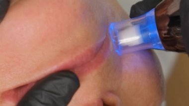 Güzellik uzmanının dermapen iğnelemesi sırasında güzel yaşlı bir kadının yakın plan portresi..