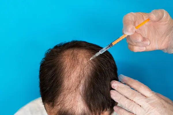 Eldivenlerinde şırınga olan bir doktor mavi arka planda alopesisi olan bir adama iğne yapıyor..