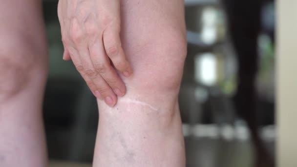 Cicatrice După Accident Picior Feminin Aproape Femeie Își Zgârie Cicatricea — Videoclip de stoc
