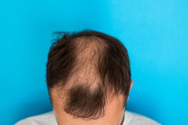 Mavi izole edilmiş arka planda genç bir adamın kel kafasının yakın çekimi..