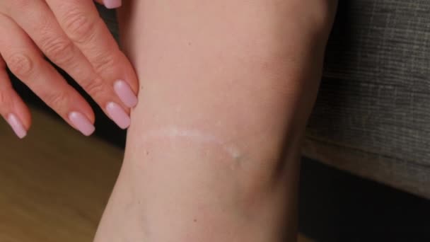 女孩腿上的刀疤特写 腿上的伤引起的静脉曲张 — 图库视频影像