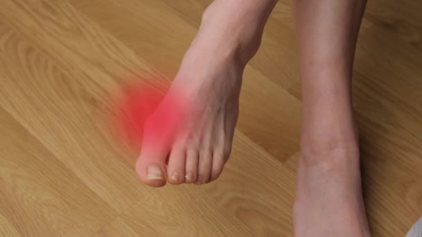 Detailní Záběr Ženských Nohou Halluxem Valgusem Bolest Nohou Červeným Světlem — Stock video