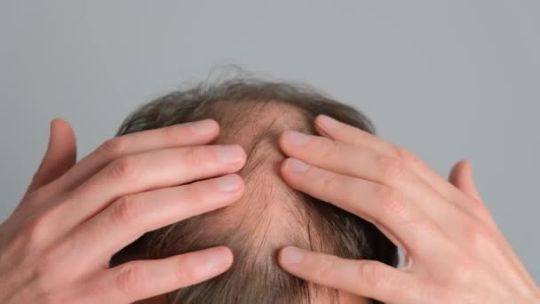 Mężczyzna Problemami Wypadaniem Włosów Zbliżenie Zbliżenie Się Młodego Mężczyzny Łysieniem — Wideo stockowe