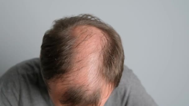 Nahaufnahme Eines Glatzköpfigen Jungen Mannes Auf Grauem Hintergrund — Stockvideo