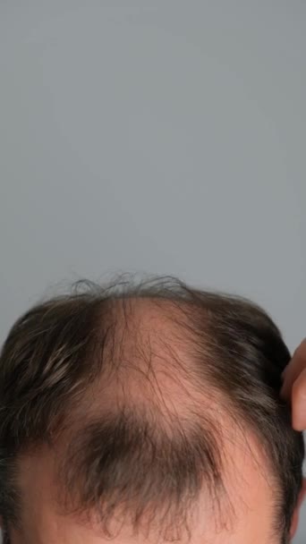 脱毛の問題を抱えている男性は閉じます 灰色の背景にアロペシアを持つ若者のクローズアップ バーティカルビデオ — ストック動画