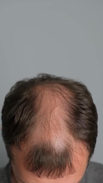 脱毛の問題を抱えている男性は閉じます 灰色の背景にアロペシアを持つ若者のクローズアップ バーティカルビデオ — ストック動画