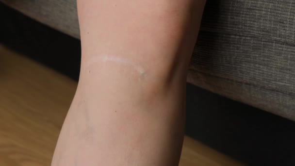Cicatriz Uma Perna Meninas Close Veias Varicosas Lesão Perna — Vídeo de Stock