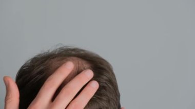 Saç dökülmesi sorunu olan bir adam. Gri arka planda alopesisi olan genç bir adamın yakın çekimi..