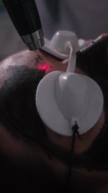 Genç ve güzel bir kızın yüzünün karbonu soyuluyor. Cilt bakımı kozmetolojisi. Lazer terapisi ve cilt tedavisi. Dikey video.