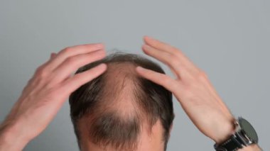 Saç dökülmesi sorunu olan bir adam. Gri arka planda alopesisi olan genç bir adamın yakın çekimi..