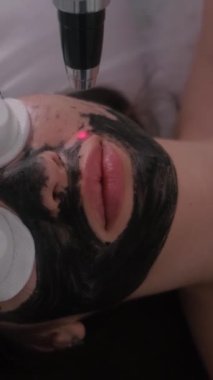 Genç ve güzel bir kızın yüzünün karbonu soyuluyor. Cilt bakımı kozmetolojisi. Lazer terapisi ve cilt tedavisi. Dikey video.
