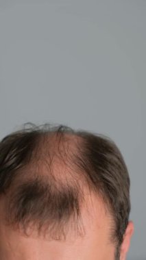 Saç dökülmesi sorunu olan bir adam. Gri arka planda alopesisi olan genç bir adamın yakın çekimi. Dikey video.