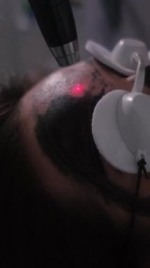Genç ve güzel bir kızın yüzünün karbonu soyuluyor. Cilt bakımı kozmetolojisi. Lazer terapisi ve cilt tedavisi. Dikey video.