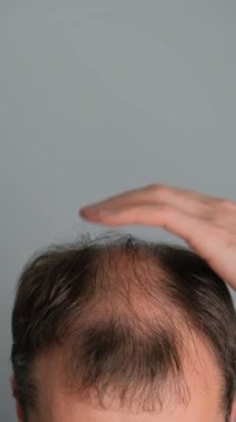 Saç dökülmesi sorunu olan bir adam. Gri arka planda alopesisi olan genç bir adamın yakın çekimi. Dikey video.