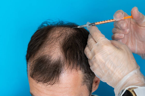 Крупный план лысой головы молодого человека на синем изолированном фоне.