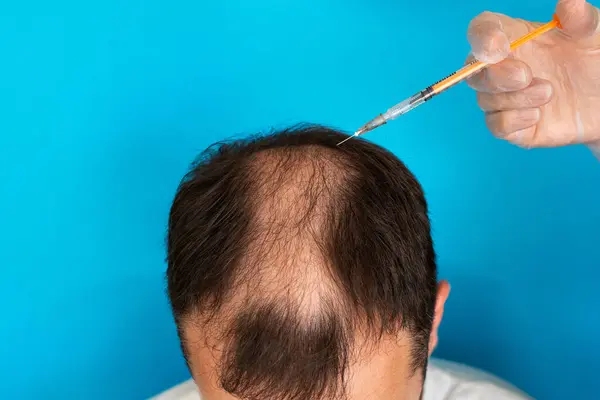 Eldivenlerinde şırınga olan bir doktor mavi arka planda alopesisi olan bir adama iğne yapıyor..