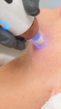 Güzellik uzmanının dermapen 'i ile mikronedling yaparken güzel yaşlı bir kadının yakın plan portresi. Dikey video.