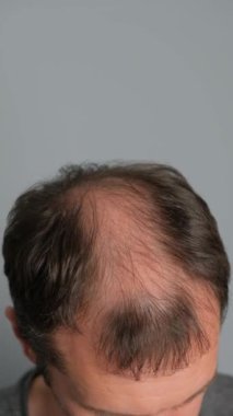 Saç dökülmesi sorunu olan bir adam. Gri arka planda alopesisi olan genç bir adamın yakın çekimi. Dikey video.