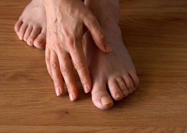 Hallux valgus şişliği ve ayak tırnağı mantarı belirtileri olan bir kadının ayağını yakından çek. Eli nazikçe baş parmağına dokunuyor. Bu da ayak sorunlarını ve tıbbi bakım ihtiyacını gösteriyor..