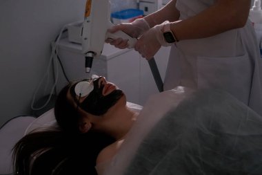 Bir kadın karbon lazer yüz tedavisi görüyor. Yüzü siyah bir karbon maskeyle kaplı, koruyucu gözlükler gözlerini koruyor..