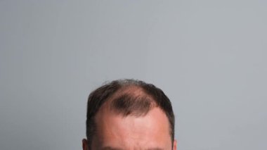 Saç dökülmesi sorunu olan bir adam. Gri arka planda alopesisi olan genç bir adamın yakın çekimi..