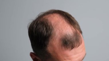 Saç dökülmesi sorunu olan bir adam. Gri arka planda alopesisi olan genç bir adamın yakın çekimi..